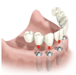 Dantų protezavimo paslaugų kainai įtaką daro daug faktorių